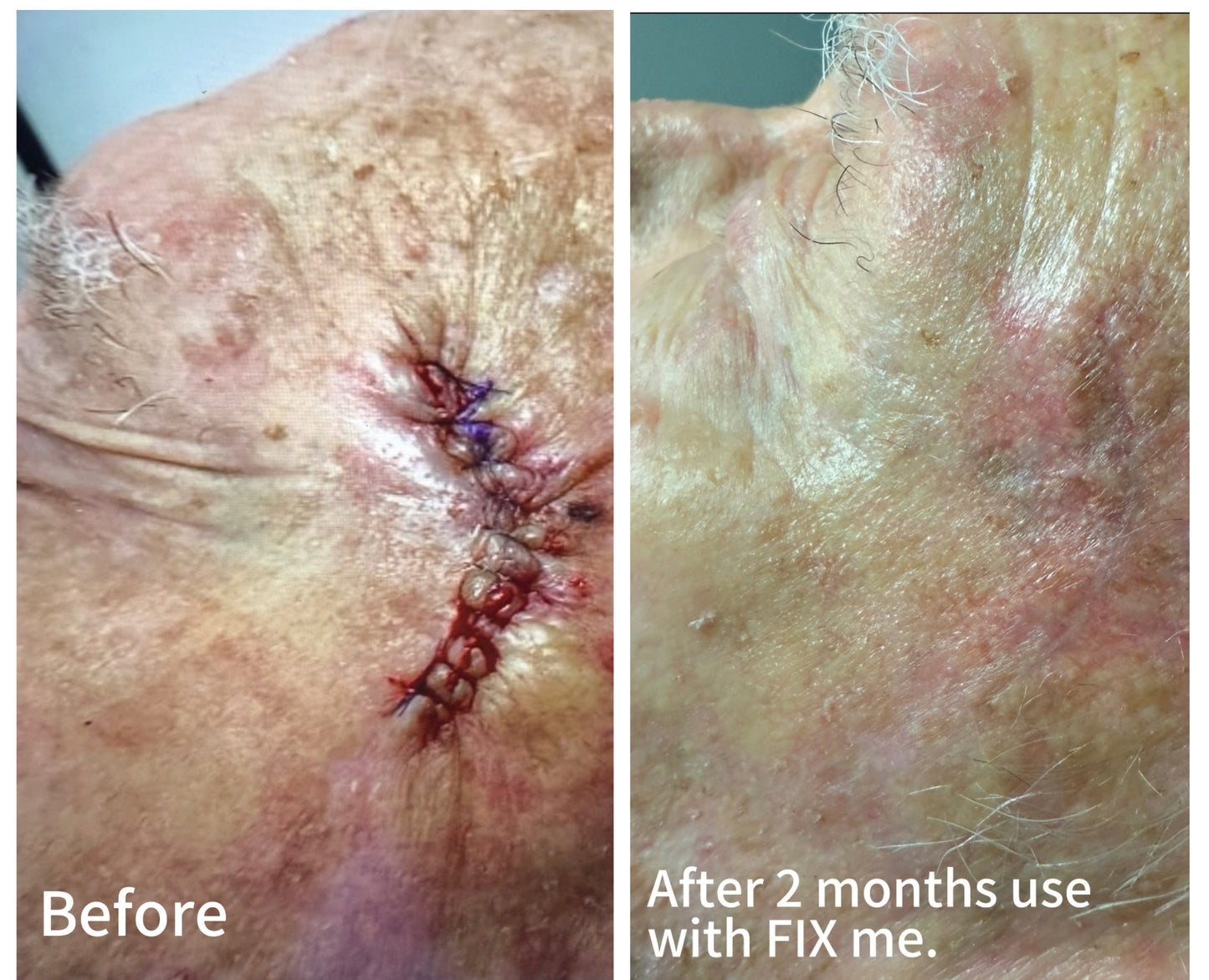 FIX me. Advanced Scar Cream